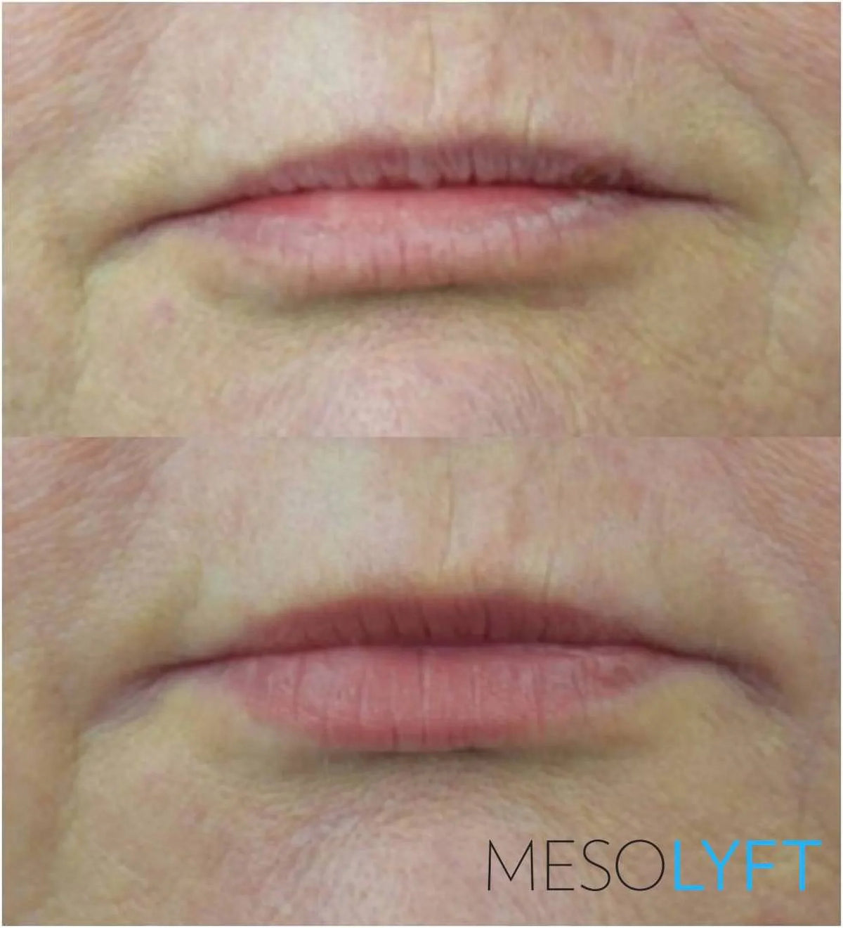 '- MESOLYFT LIP Plumper