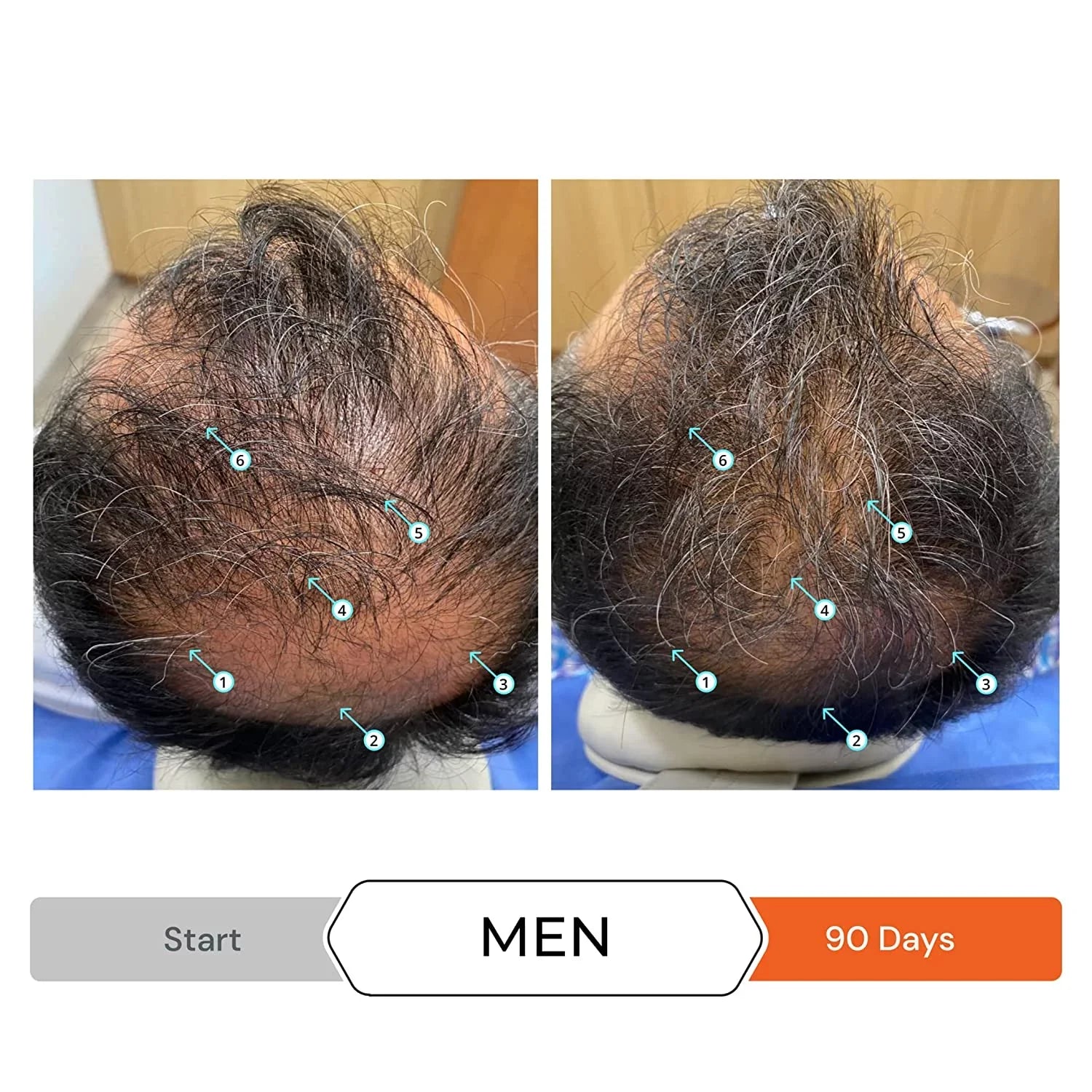 DHT w/DNC-N Shampoo Block and Nanoxidil Growth Caffeine Stimulating Hair Regrowth Treatment Ingredients, Hair 5% Helps w/Biotin, Revita