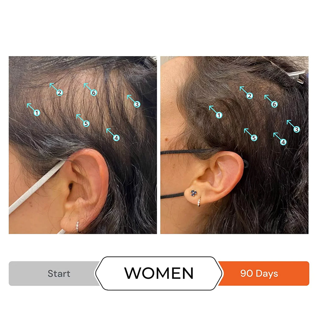 DHT w/DNC-N Shampoo Block and Nanoxidil Growth Caffeine Stimulating Hair Regrowth Treatment Ingredients, Hair 5% Helps w/Biotin, Revita