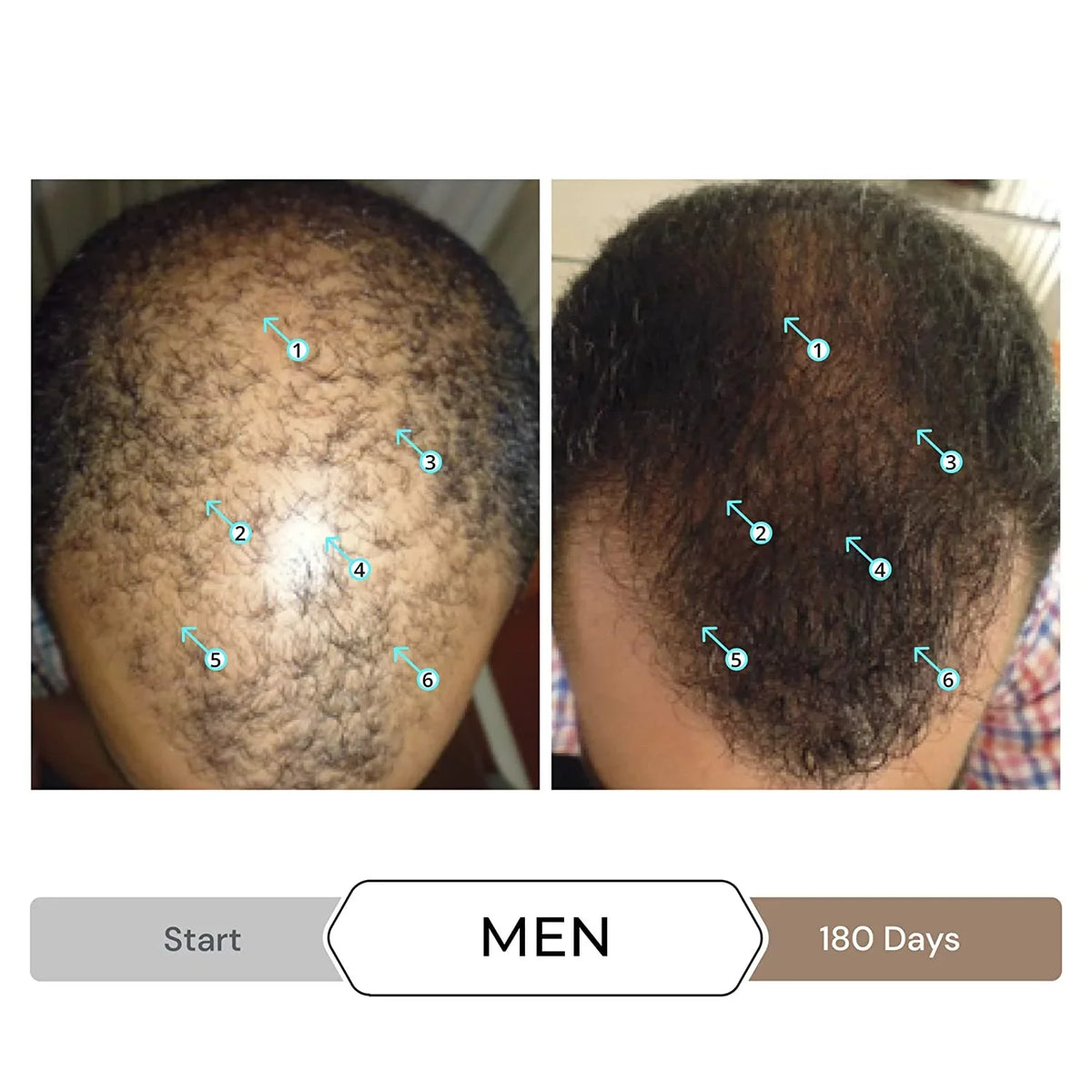 DHT w/DNC-N Shampoo Block and Nanoxidil Growth Caffeine Stimulating Hair Regrowth Treatment Ingredients, Hair 5% Helps w/Biotin, Revita