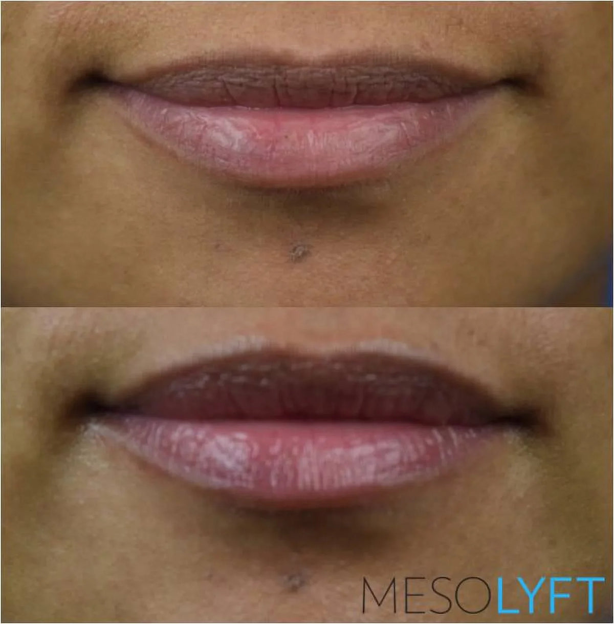 '- MESOLYFT LIP Plumper